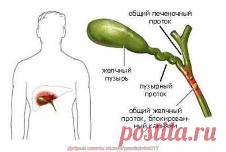 Очищение желчного пузыря народными средствами.