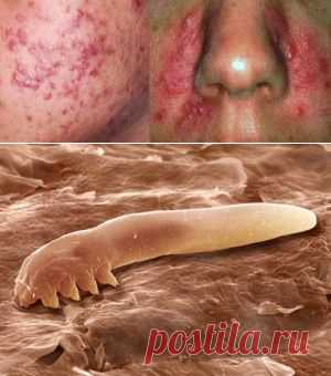 Лечение демодекоза – причины прыщей и угрей | vita-jizn.net
Лечение демодекоза начинают с анализа на клещ демодекс, и если его обнаружили, то только врач назначит, как вылечить демодекоз. 6 народных средств от демодекоза
Лечение демодекоза откладывать нельзя!