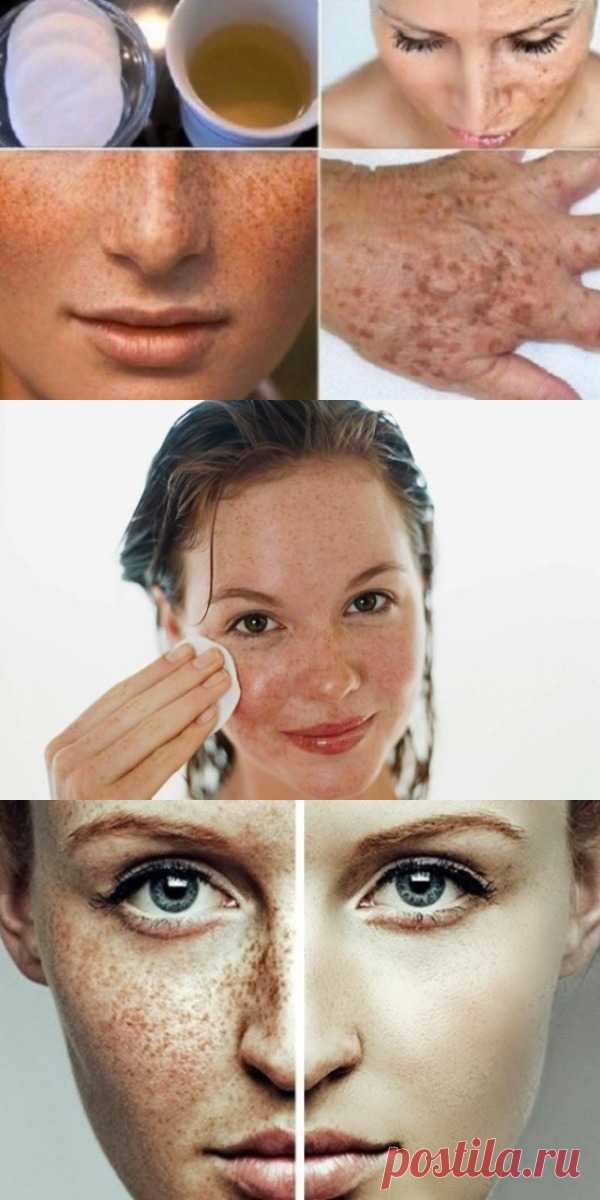 Отбелите кожу и очистите её от веснушек и темных пятен с помощью этого лосьона!