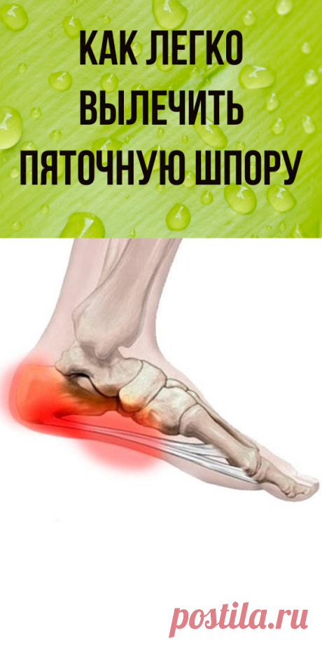 Как легко вылечить пяточную шпору