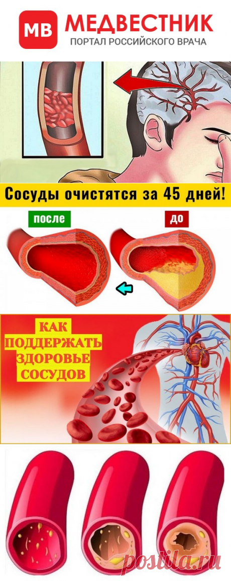 АНГИОДИСТОНИЯ СОСУДОВ ГОЛОВНОГО МОЗГА: ПРИЧИНЫ, МЕХАНИЗМЫ, СИМПТОМЫ.