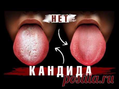 Начните делать это сейчас – и избавитесь от кандидоза навсегда!👍