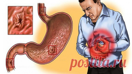 10 причин заподозрить у себя язву желудка — Домашние заботы