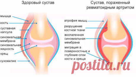 Ревматоидный артрит: народное лечение приносит облегчение! Если боль взяла в «плен» пора выбираться