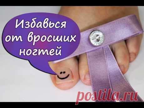 Как навсегда избавиться от вросшего ногтя (делаем педикюр правильно)