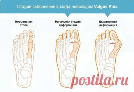 «Valgus Plus» - корректор для большого пальца. Избавьтесь от “косточки на ноге” всего за 1 месяц с уникальным фиксатором для коррекции деформированного большого пальца.