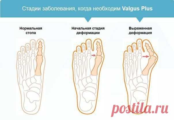 «Valgus Plus» - корректор для большого пальца. Избавьтесь от “косточки на ноге” всего за 1 месяц с уникальным фиксатором для коррекции деформированного большого пальца.