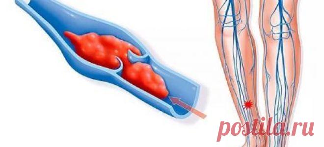 Эффективное средство от тромбов в сосудах | Polza-vred.su