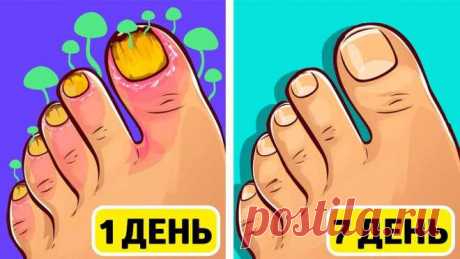 Считаете, что грибок обошел вас стороной? Если вы заметили хотя бы один симптом у себя, то начните лечение уже сегодня Неприятный запах Трещины и шелушение Неправильная форма ногтя Ноготь становится коричневым или желтым Бороздки и белые пятна на ногте Зуд и жжение Волдыри на стопах Онемение и покалывание Местные уплотнения кожи в области стопы Что будет, если не лечить грибок стопы