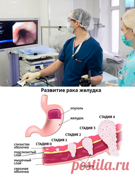 Рак желудка: что нужно об этом знать?