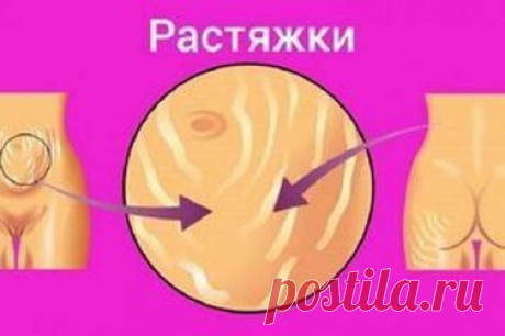 Куда делись растяжки? Копеечное средство из аптеки сделало кожу божественной Кожа — самый большой орган человеческого тела. Всё в нашем организме связано, и состояние кожи зависит от множества факторов, количество которых сложно сосчитать. Сегодня ты узнаешь, что именно нужно предпринять, для полного избавления от растяжек на коже. Если кто-то скажет, что это невозможно, таинственно улыбайся в ответ. Нужно всего лишь победить свою лень, и кожа преобразится волшебным образо...