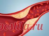 Атеросклероз - 