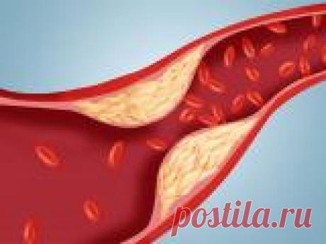 Атеросклероз - "ржавчина жизни". Методы лечения атеросклероза Атеросклероз - "ржавчина жизни". Методы лечения атеросклероза


Лечебное питание
Основа всех диет по снижению холестерина - уменьшение потребления жиров животного происхождения (жирное мясо, субпродук…