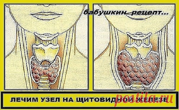 ЛЕЧИМ УЗЕЛ НА ЩИТОВИДНОЙ ЖЕЛЕЗЕ 

НАМ ПОТРЕБУЕТСЯ:

ГРЕЧНЕВАЯ КРУПА
ГРЕЦКИЕ ОРЕХИ
МЕД

Смешайте по одному стакану молотой гречневой крупы, пропущенных через мясорубку грецких орехов и меда в эмалированной (абсолютно чистой) посуде и переложите в стеклянную банку. Один раз в неделю за целый день съешьте этот состав, не принимая больше никакой пищи, кроме воды. 

Сделайте так шесть раз, т. е. шесть недель. Затем через месяц повторите лечение. Уже после первого курса зоб умен...