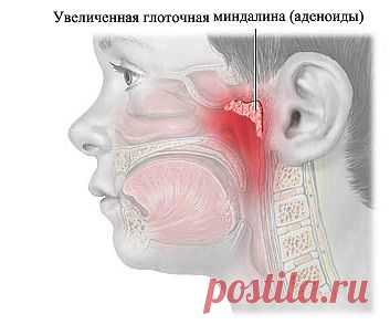 zulfia: Подросли детки - подросли и бедки. Аденоиды.