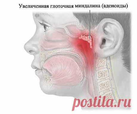 zulfia: Подросли детки - подросли и бедки. Аденоиды.