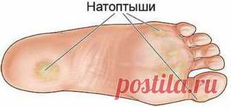 Простые рецепты для устранения натоптышей, трещин, мозолей, сосудистой сетки и варикоза
