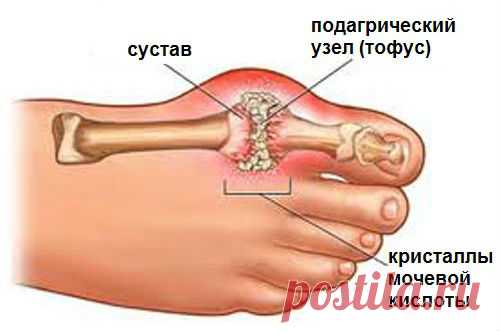 Как лечить отложение солей в суставах натуральными средствами — Здоровое Долголетие