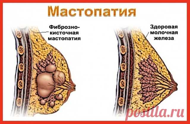 лечение мастопатии народными средствами