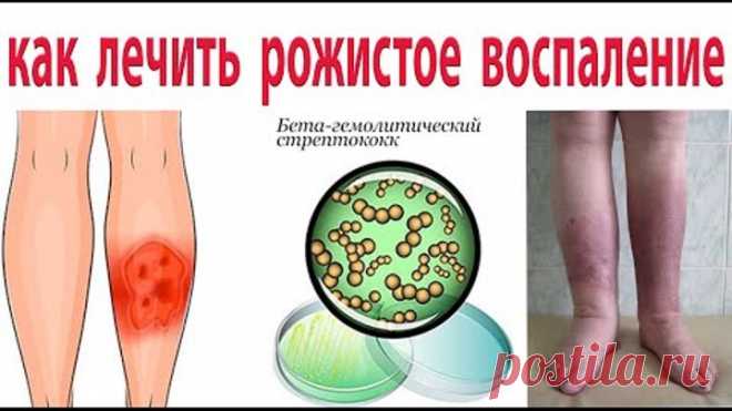 Все Врачи знают, как вылечить рожистое воспаление (рожу). 100% результат