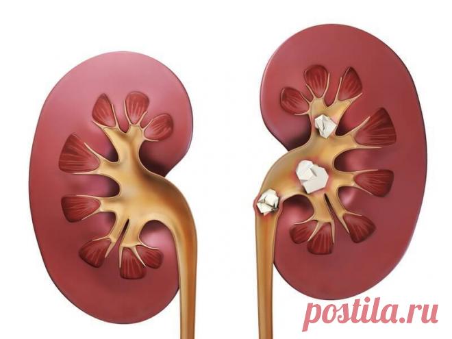 Лечение народными средствами. Почечнокаменная болезнь Для предупреждения почечнокаменной болезни большое значение имеет общегигиенический режим, правильное питание, двигательная активность…