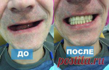 Съемное протезирование зубных имплантов недорого в Химках | MEDIVEL