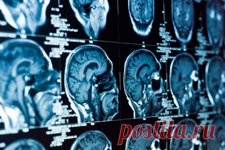 Искусственный интеллект научился анализировать результаты КТ. Искусственный интеллект в платформе для поддержки принятия врачебных решений «Цельс» стал анализировать результаты компьютерной томографии головного мозга. «ИИ ищет очаги кровоизлияния и в течение нескольких минут выдает результат, помогая врачам быстрее принять решение об экстренной помощи», — говорится в сообщении.