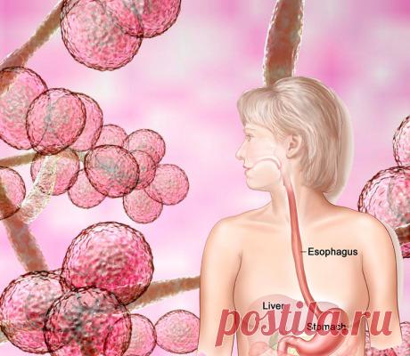 Холистическое лечение кандидозная инфекции Грибы Candida albicans обитают в организме человека. Но когда их становится слишком много, у человека может развиться аллергия, астма, синдром раздраженного кишечника и другие заболевания, казалось бы, никак не связанные с кишечной микрофлорой. Вот несколько стратегий, чтобы победить Candida albicans.