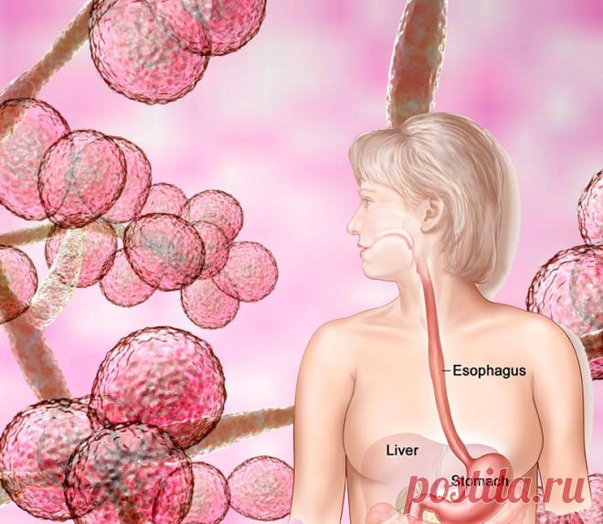 Холистическое лечение кандидозная инфекции Грибы Candida albicans обитают в организме человека. Но когда их становится слишком много, у человека может развиться аллергия, астма, синдром раздраженного кишечника и другие заболевания, казалось бы, никак не связанные с кишечной микрофлорой. Вот несколько стратегий, чтобы победить Candida albicans.