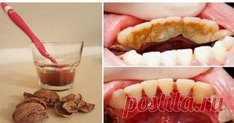 Как избавиться от зубного камня при помощи 1 простого средства. Коричневый или желтый налет на зубах можно удалить дома! Зубной камень — распространенная проблема, и современная стоматология предлагает множество