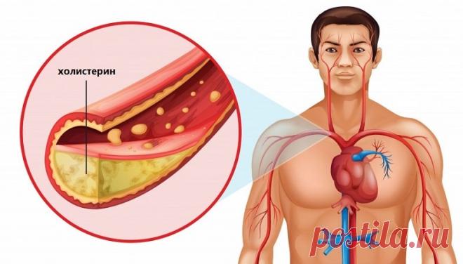 Как снизить холестерин в крови в домашних условиях быстро и эффективно Проблема холестеринового обмена в последнее время является одной из ключевых моментов в сохранении здоровья современного человека. Нарушение количественного состава липопротеинов различной плотности в крови и вызывает массу хронических заболеваний, которые постепенно приводят к преждевременной смерти. В настоящее время разработано множество медикаментов, которые нормализуют холестериновый обмен и снижаю...