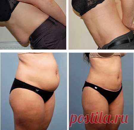 Копеечная мазь + массаж: помогли мне убрать висячий жир с живота за 20 процедур (нет возврата)! | Худеем Дома | Яндекс Дзен