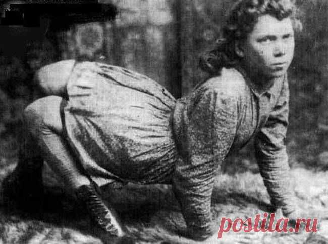 Трудно поверить, но эти 5 человек с аномалиями действительно существовали! Их истории невероятны...