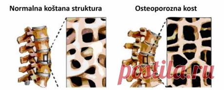 Ne dopustite da vas lažu: Za OSTEOPOROZU postoji prirodni lijek koji čudesno djeluje! – Narodni Recepti