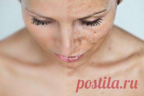 Пигментные пятна: как избавиться от них в домашних условиях | Первая помощь