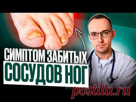 5 ПРИЗНАКОВ ЗАБИТЫХ СОСУДОВ НОГ. Как проверить дома без врача?
