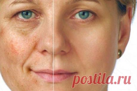 КАК ИЗБАВИТЬСЯ ОТ ПИГМЕНТНЫХ ПЯТЕН НА ЛИЦЕ
