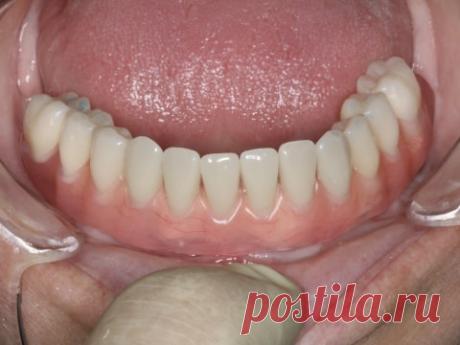 Пример протезирования при полном отсутствии зубов на нижней челюсти