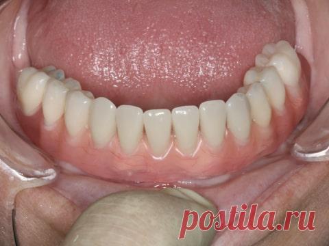 Пример протезирования при полном отсутствии зубов на нижней челюсти