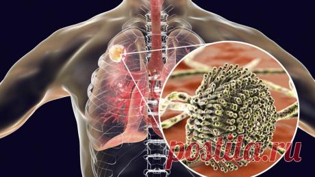 Грибок в легких: причины, симптомы, лечение | ОкейДок | Яндекс Дзен