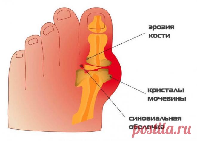 Как облегчить боль при подагре / Будьте здоровы