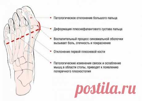 «Вальгусная деформация первого пальца стопы  Hallux Valgus. Вальгусная деформация первого пальца стопыПоражения стоп начинают встречаться все чаще и чаще. Одной из наиболее часто встречающихся видов патологии суставов стопы является вальгусная д... Данным вопросом часто задаются многие люди. Для некоторых развитие подобной деформации – катастрофа, так как данная группа людей свято бережет свою внешность и не может допустить, чтобы неприятный дефект ...