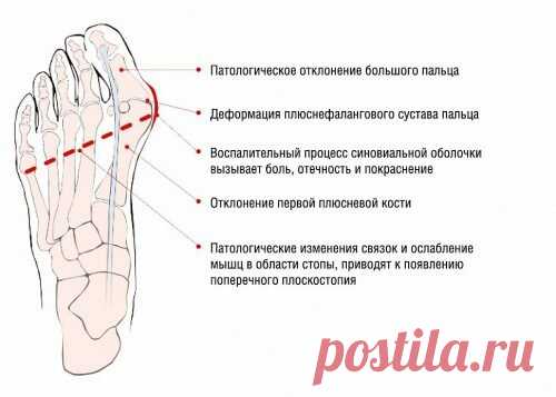 «Вальгусная деформация первого пальца стопы  Hallux Valgus. Вальгусная деформация первого пальца стопыПоражения стоп начинают встречаться все чаще и чаще. Одной из наиболее часто встречающихся видов патологии суставов стопы является вальгусная д... Данным вопросом часто задаются многие люди. Для некоторых развитие подобной деформации – катастрофа, так как данная группа людей свято бережет свою внешность и не может допустить, чтобы неприятный дефект ...