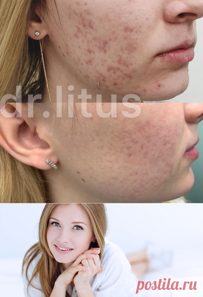 ТЕРАПИЯ ПОСТАКНЕ ▷ РЕАЛЬНЫЕ РЕЗУЛЬТАТЫ
👉 Актуальную тему тяжелой степени угревой болезни и терапии постакне разбираем с нашим врачом-дерматологом Ириной Литус.