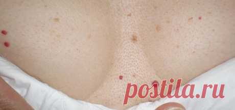 Красные родинки на теле. Причины появления. – Женский сайт Femme Today
