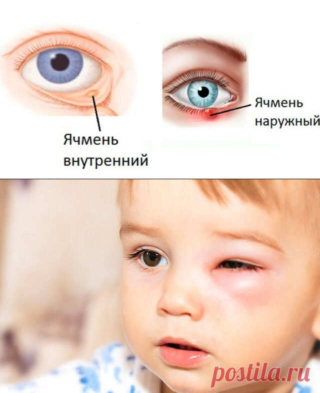Как в домашних условиях быстро вылечить ячмень на глазу — Бабушкины секреты