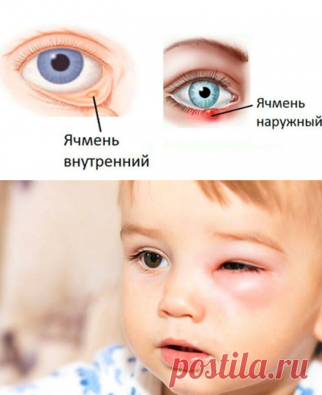 Как в домашних условиях быстро вылечить ячмень на глазу — Бабушкины секреты