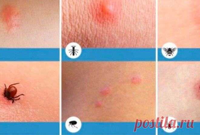 ВАЖНО! 8 типов укусов насекомых, о которых вы просто обязаны знать! Весной и летом повышается риск получить укус мелких насекомых. Чтобы избежать последствий и при необходимости оказать первую помощь, важно научиться различать укусы и знать, какими средствами обрабатывать раны, при каких симптомах и в каких сроках необходимо обратиться к врачу.