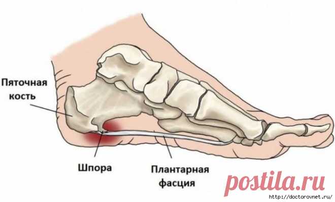 Лечебный раствор аспирина при шпорах, варикозе и остеохондрозе