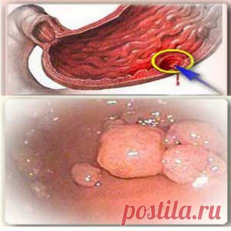Лечение язвы и полипов желудка